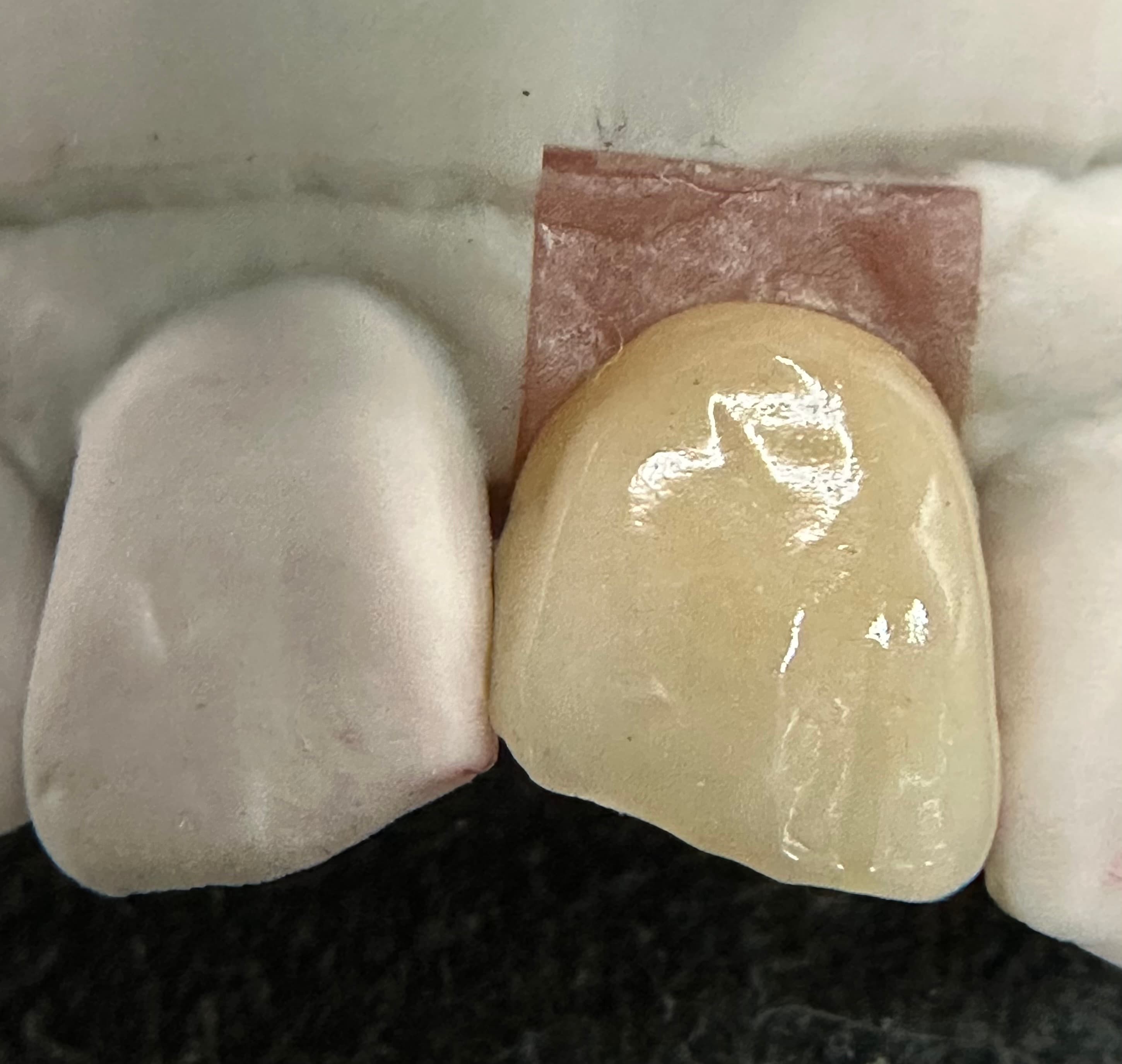 Emergence Critical Central Implant Crowns