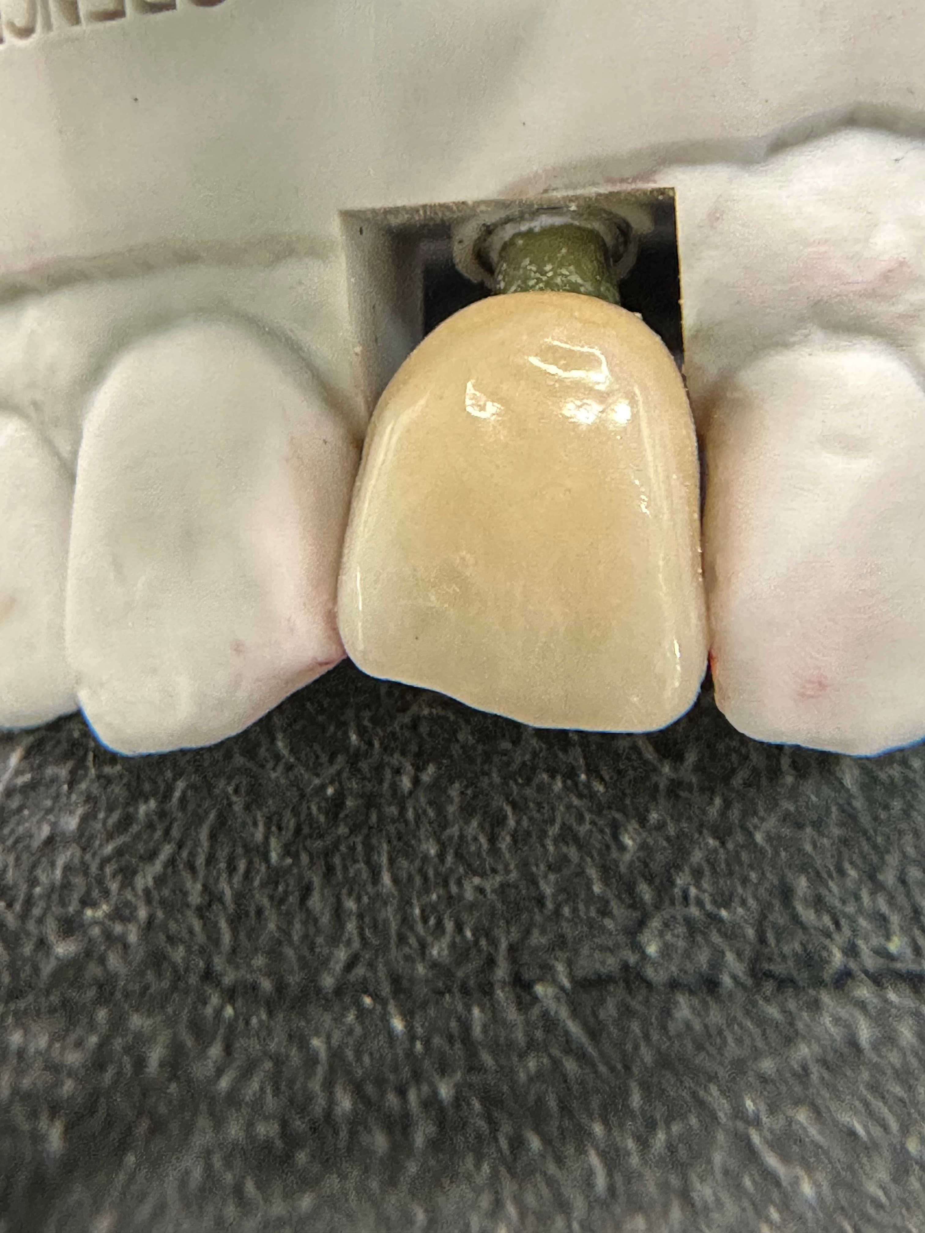 Emergence Critical Central Implant Crowns – image 5