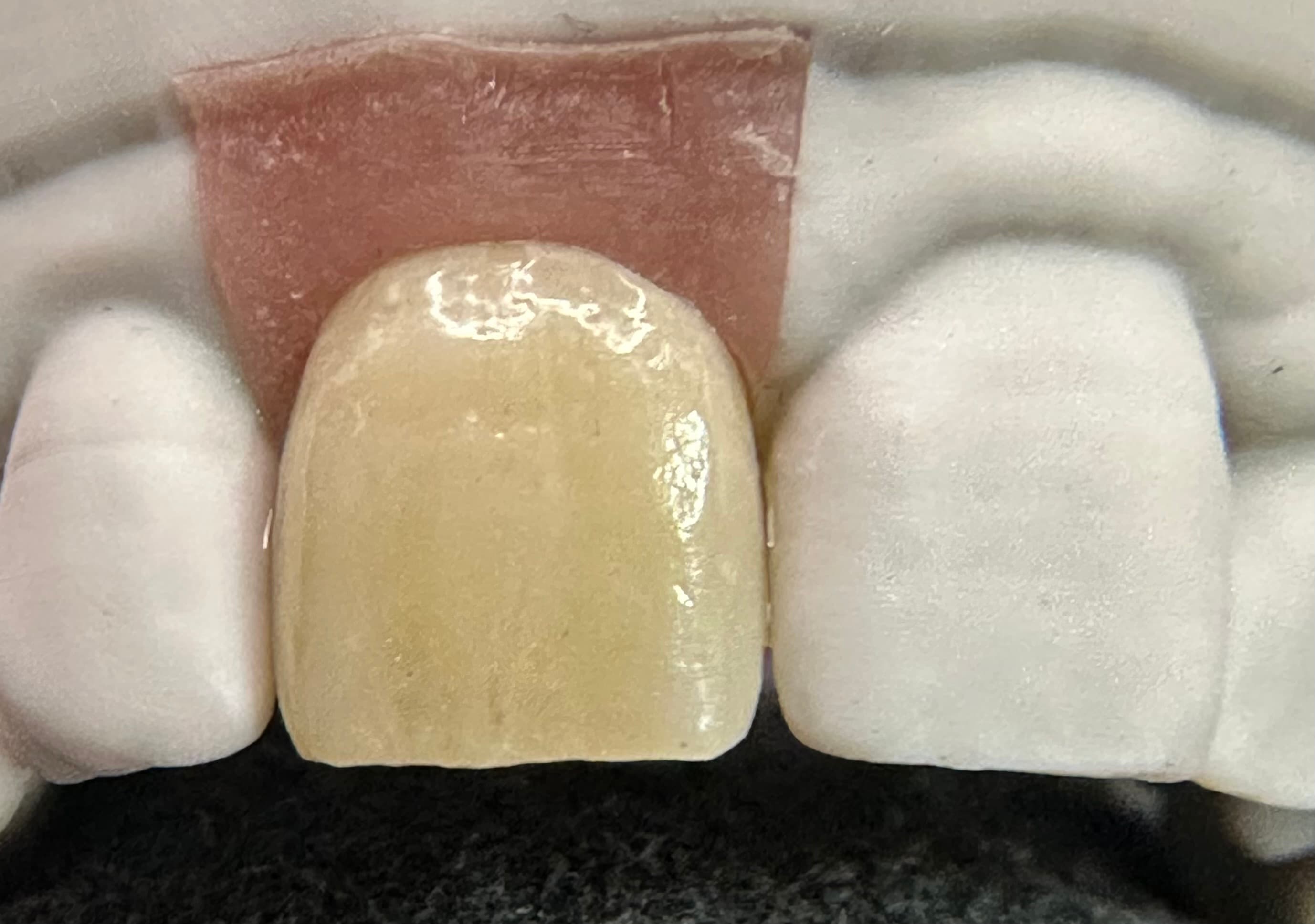 Emergence Critical Central Implant Crowns – image 6