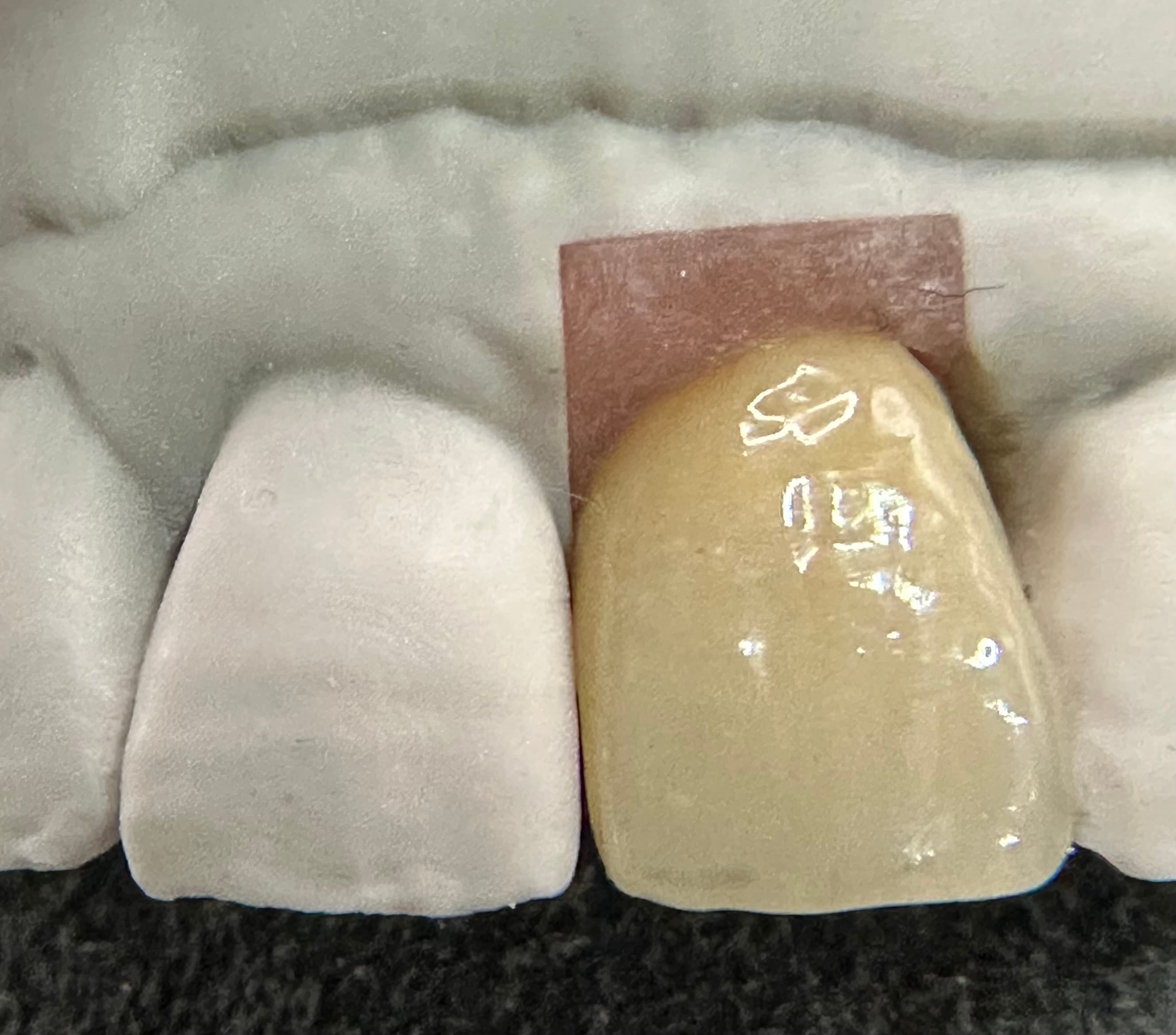 Emergence Critical Central Implant Crowns – image 7