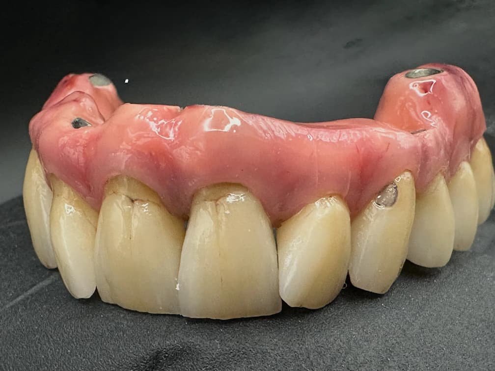 Fusion Zirconia Cutback & layered with monolithics