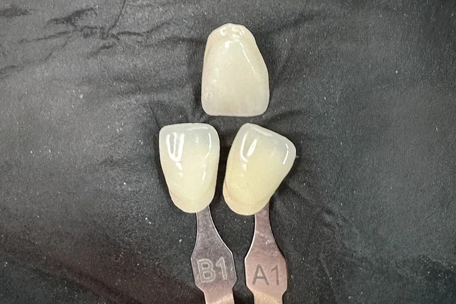 Shade adjustment process for a difficult case