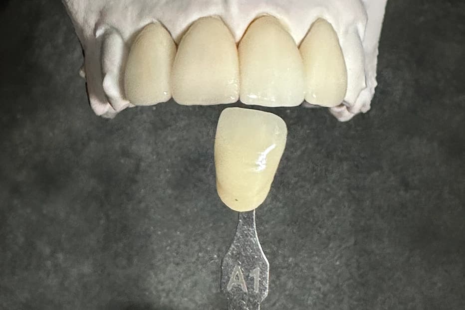 Translucent All Ceramics