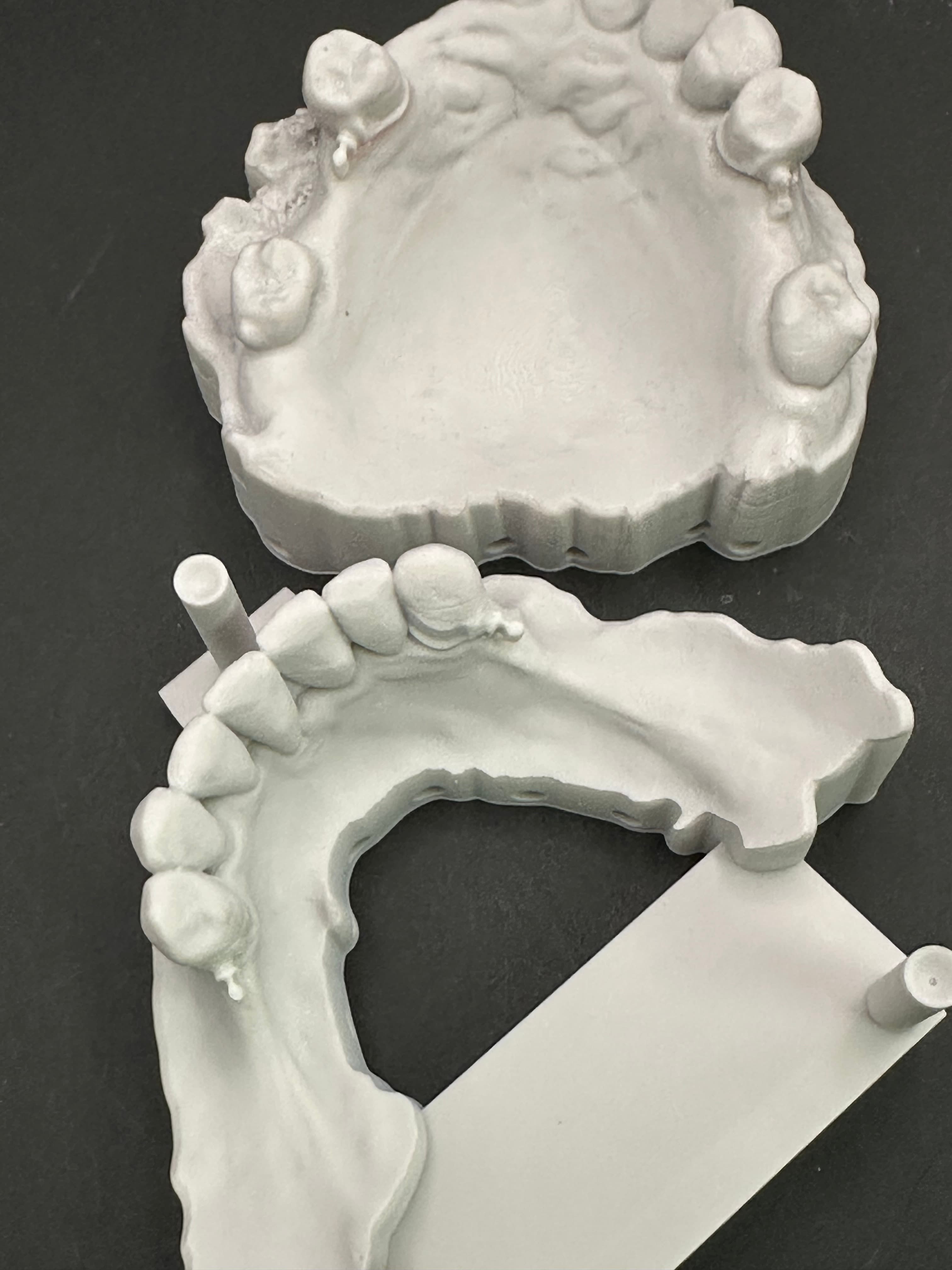 Complex Upper & Lower 3D Printed RPDs – image 3