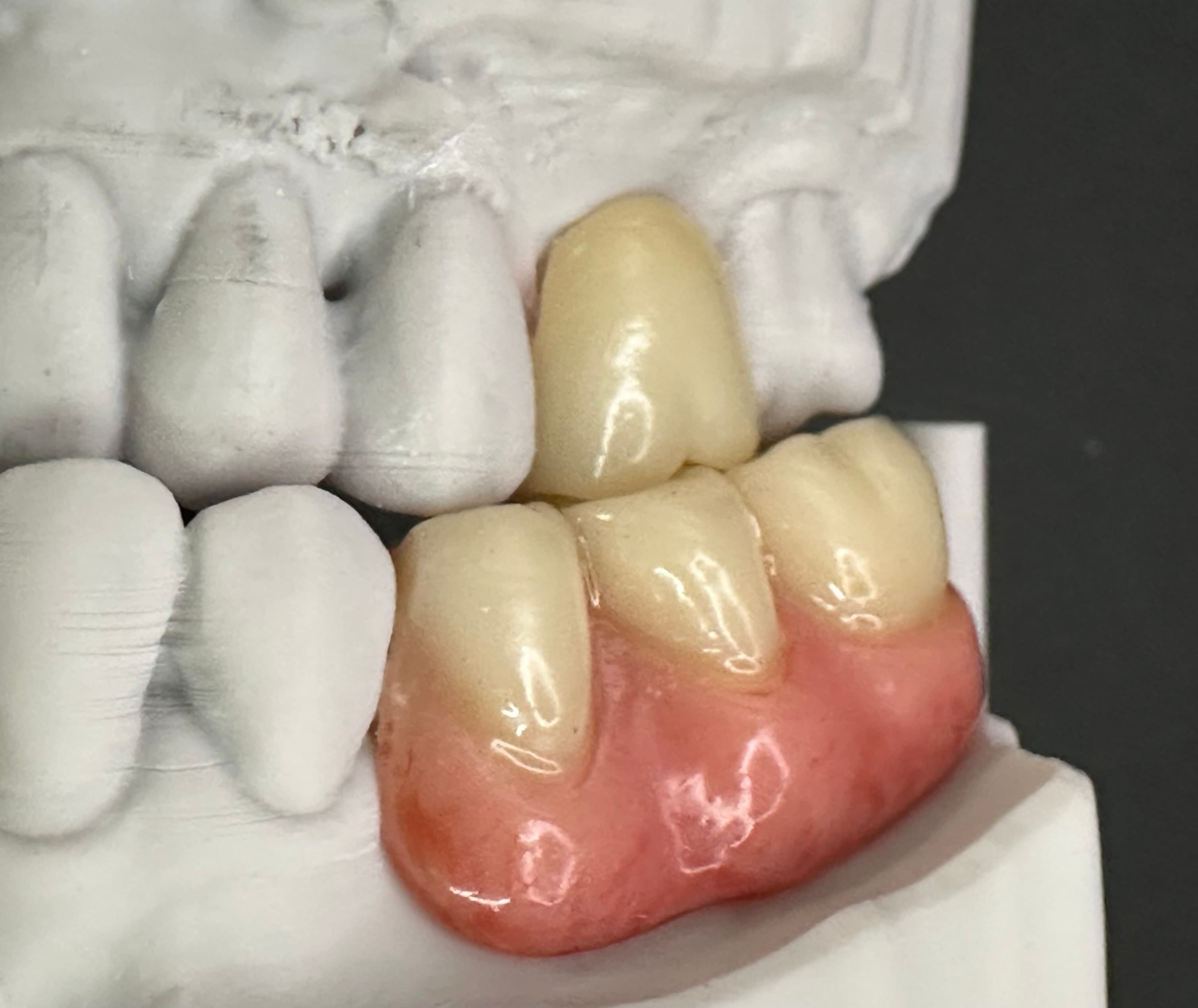 Complex Upper & Lower 3D Printed RPDs – image 5