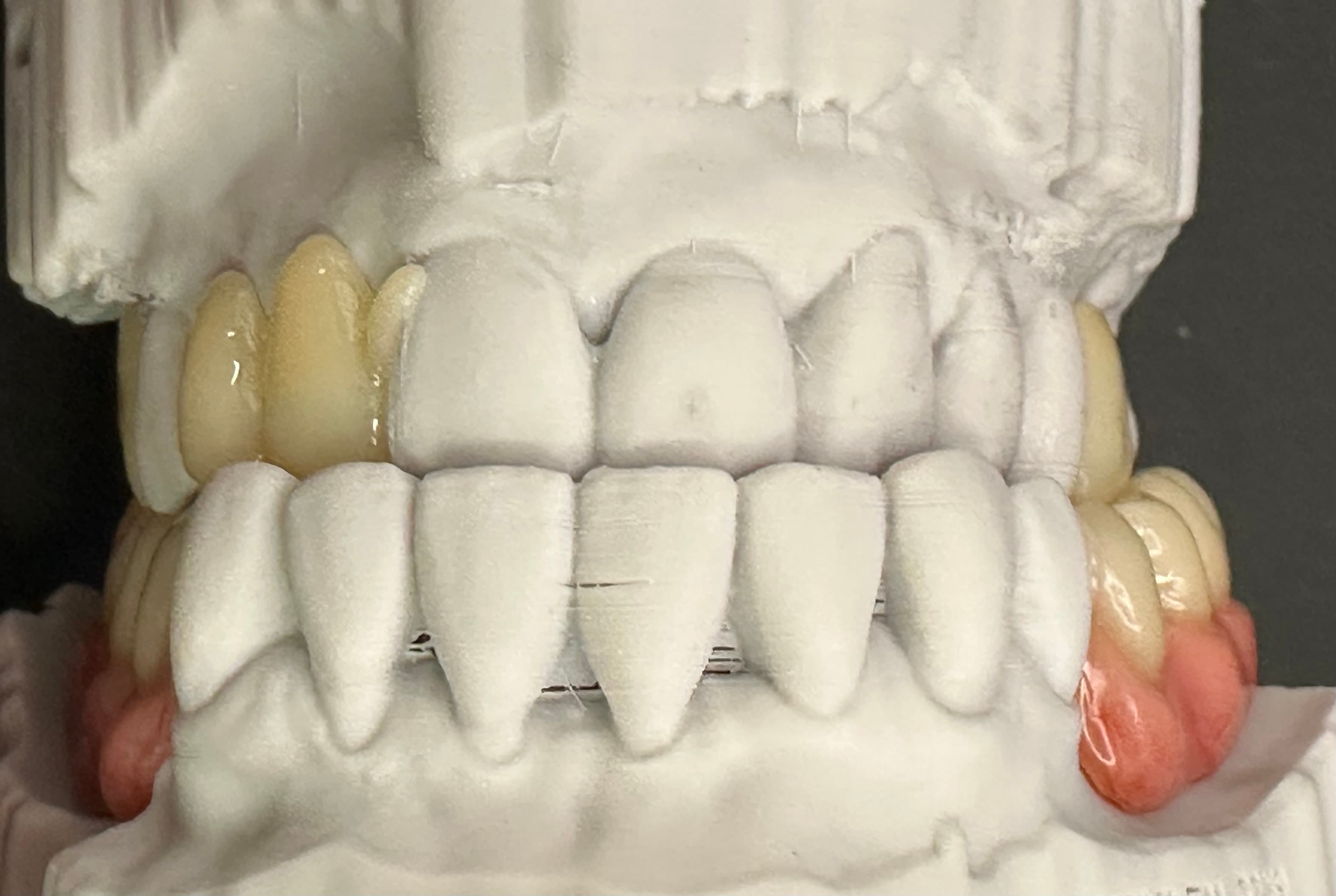 Complex Upper & Lower 3D Printed RPDs – image 6