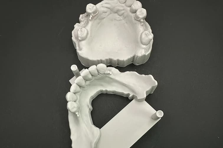 Complex Upper & Lower 3D Printed RPDs