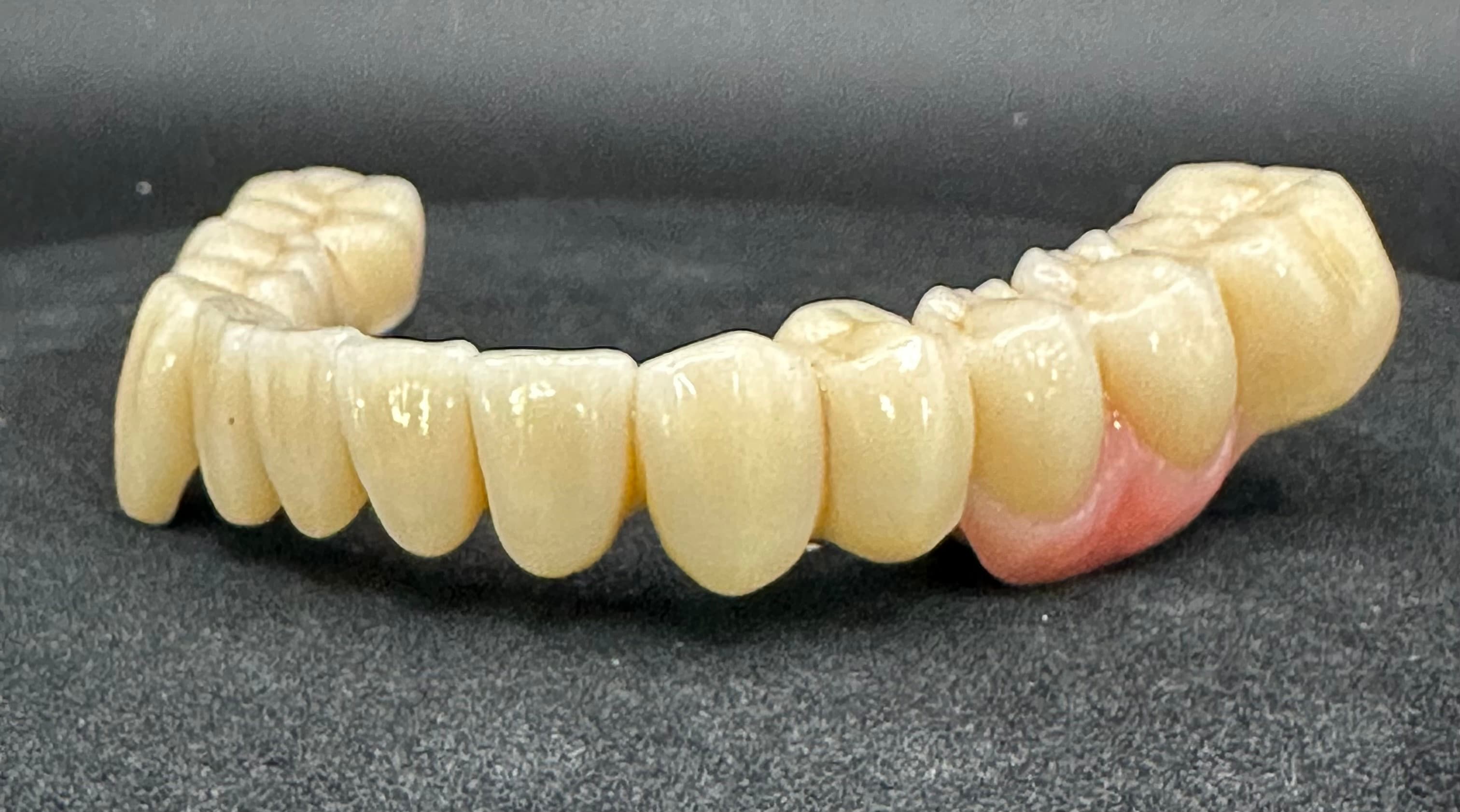 Lower Removable PFM Full Arch Bridge – image 2