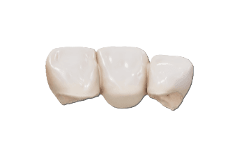 Anterior 3 Unit Bridge