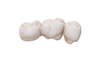 Posterior 3 Unit Bridge