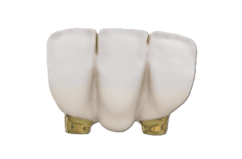 Anterior 3 Unit Bridge