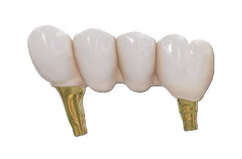 Posterior 3 Unit Bridge