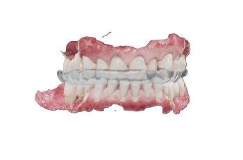 Splint