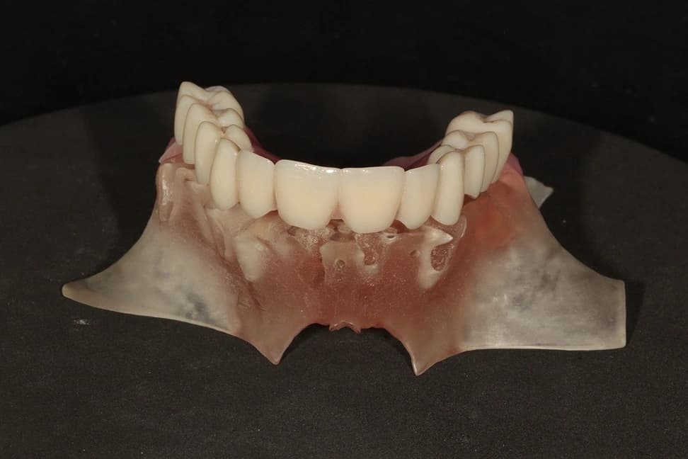 Stage 11: Transitional Bridge in location (post-op extended)