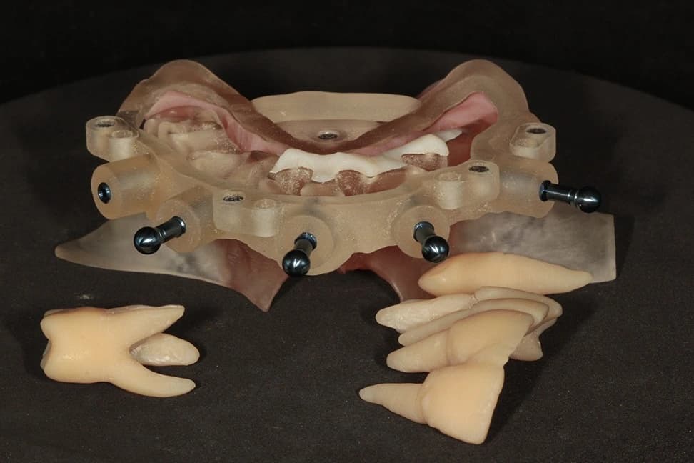Stage 4: Fixation Pin Guide in Situ. Teeth to be XLA