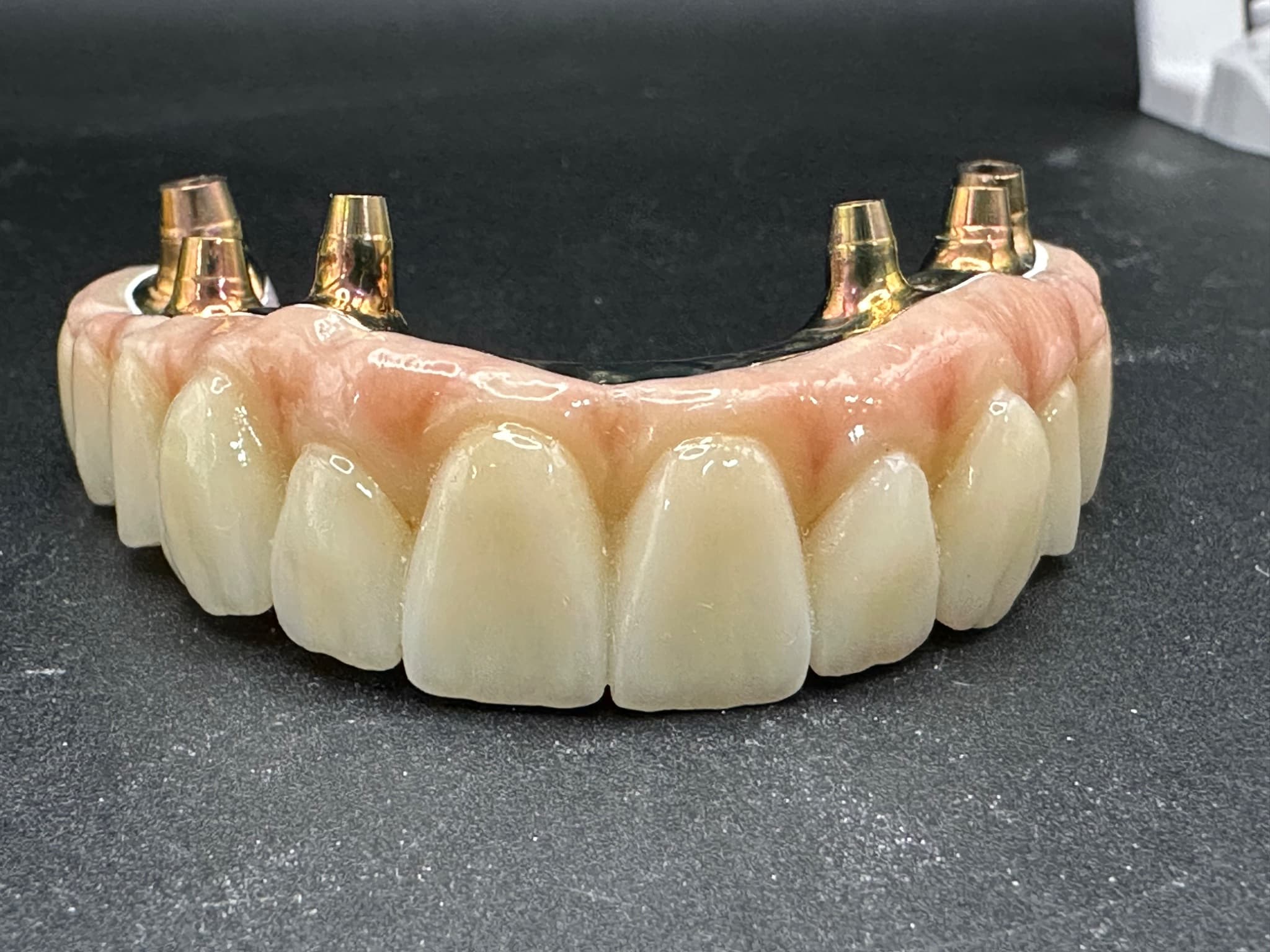 Image: implant-supported upper arch monolithic zirconia on milled titanium bar