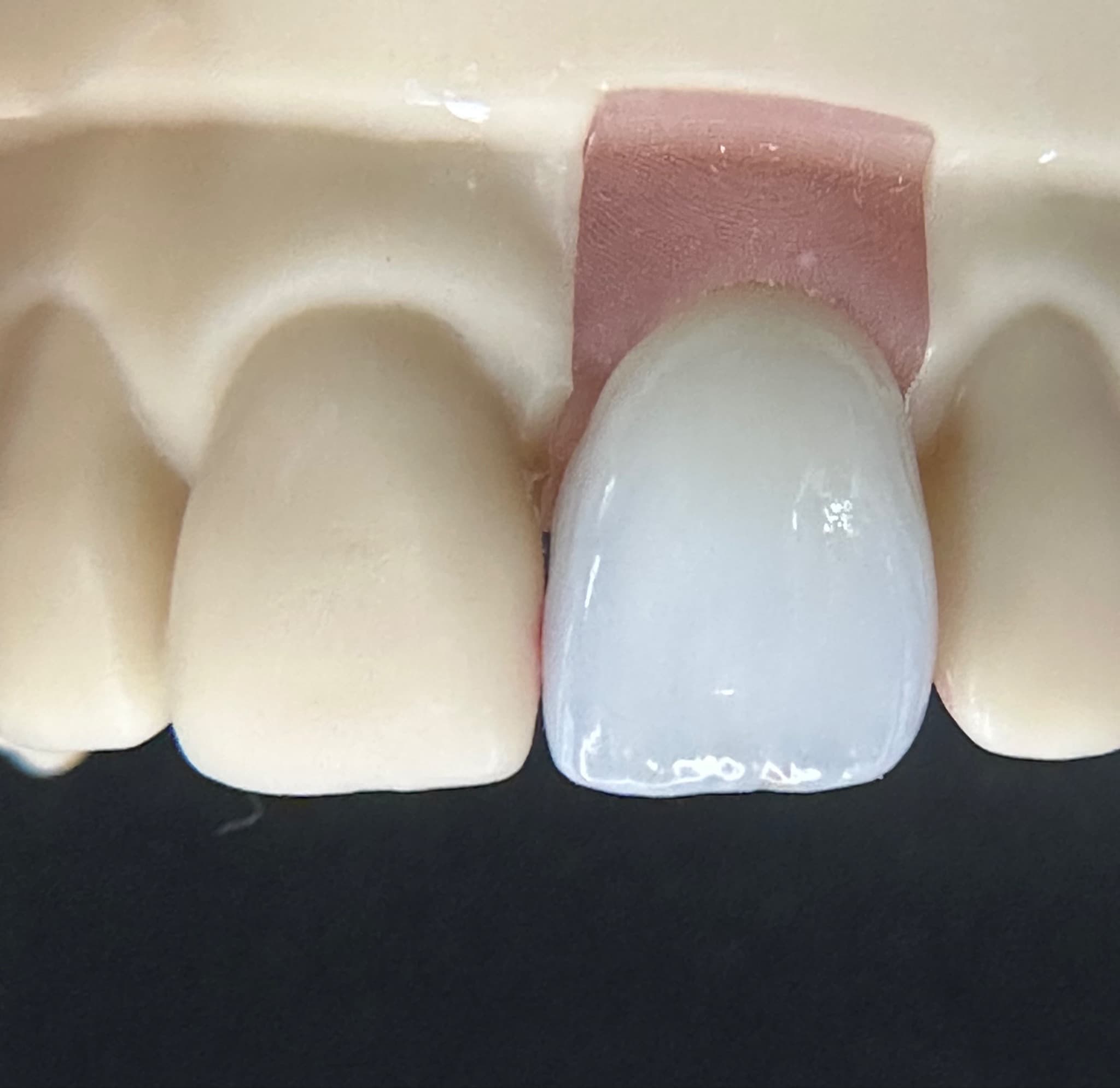 Images: 1, 2 & 3 show higher position in-puck-placed UL1 youthful implant crown maximising the translucency zone