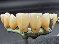 Image: Hybrid implant-supported Ti-bar with monolithic & layered zirconia crowns; titanium milled bar with hand-layered gingival effect composites Images 2 & 3 show component parts