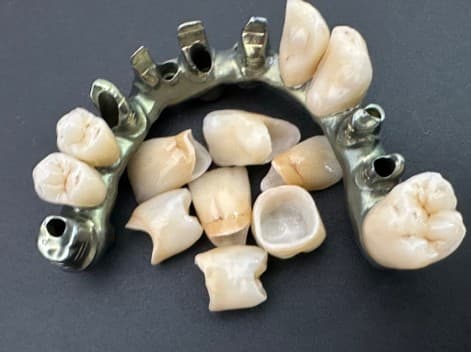 Image: Hybrid implant-supported Ti-bar with monolithic & layered zirconia crowns; titanium milled bar with hand-layered gingival effect composites Images 2 & 3 show component parts