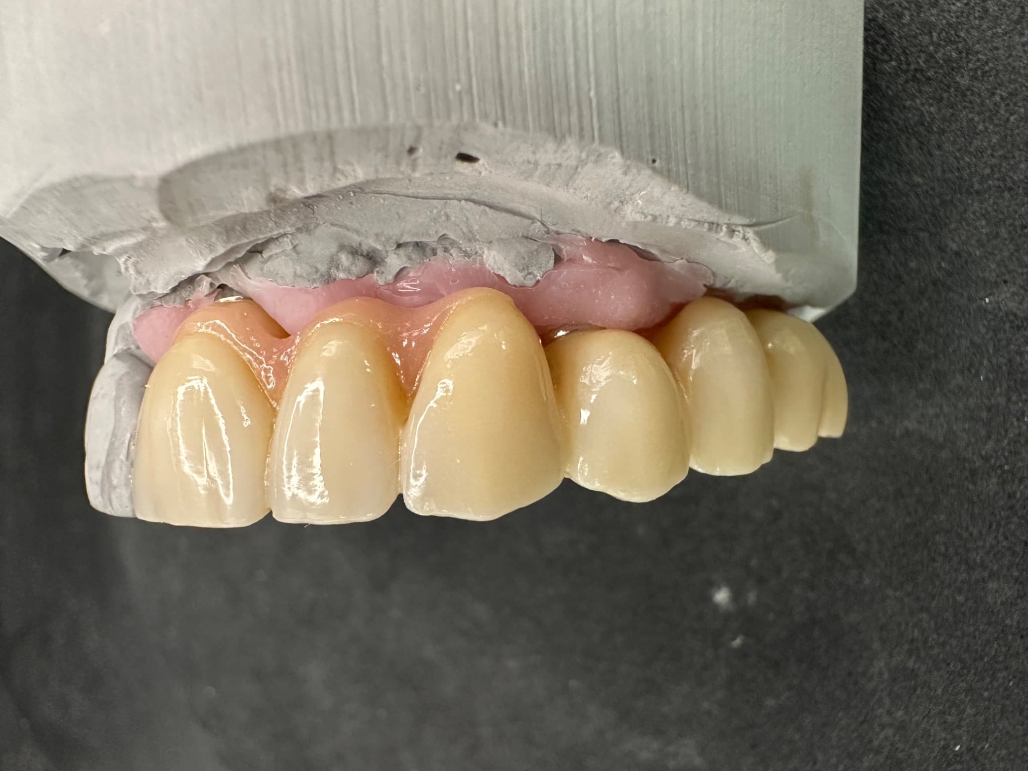 Image: 6-unit zirconia bridgework with layered ceramic in the aesthetic zone