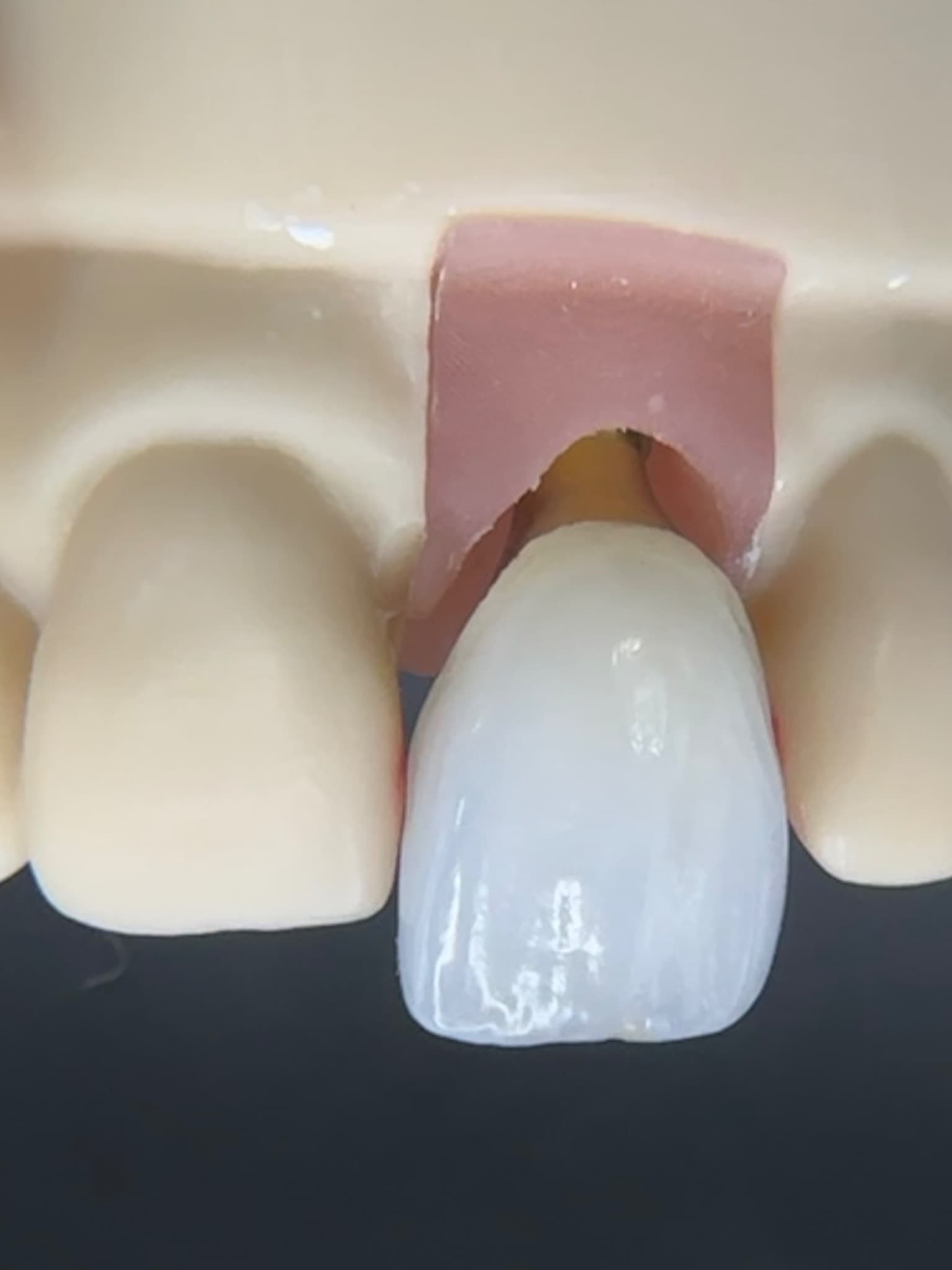 Images: 1, 2 & 3 show higher position in-puck-placed UL1 youthful implant crown maximising the translucency zone