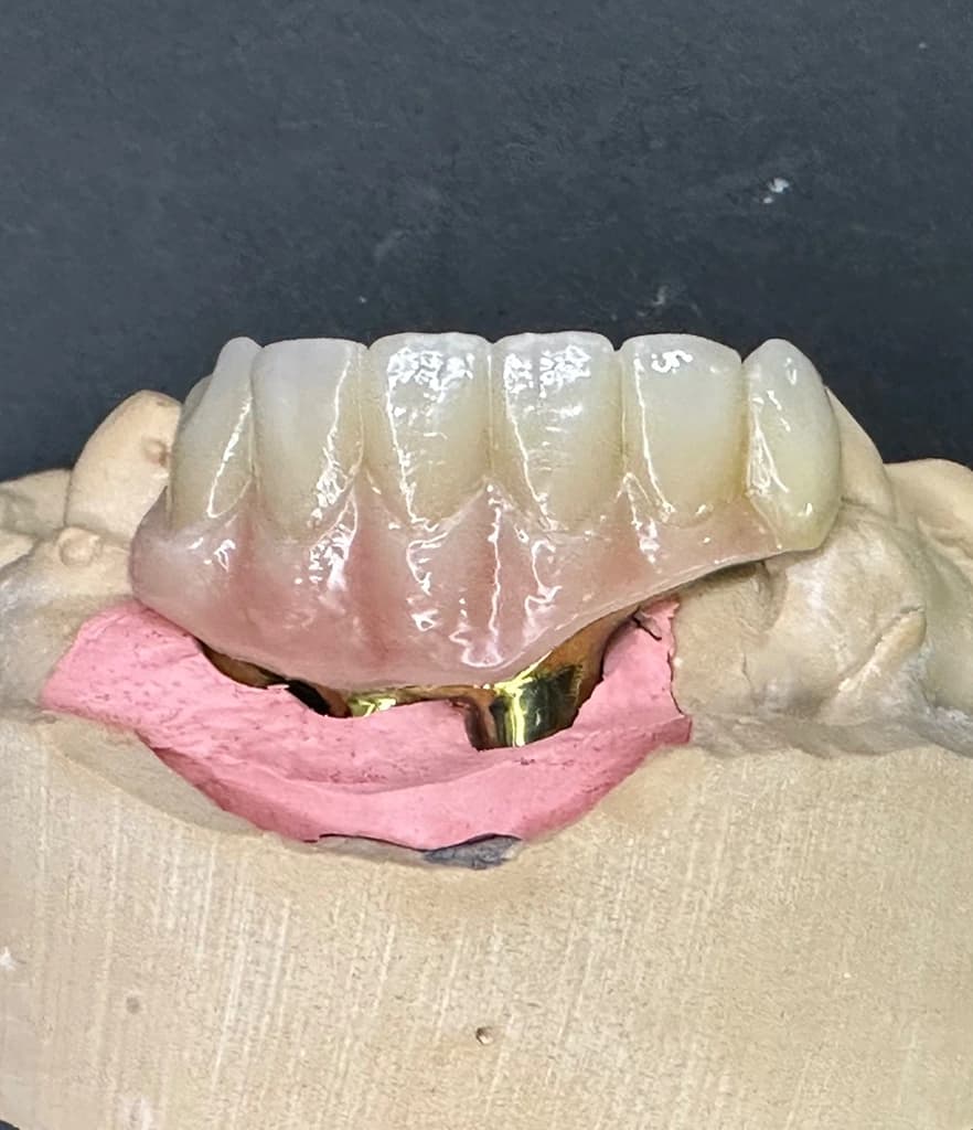 Multiple implant supported 6 unit monolithic Fusion Zirconia, Lab-bonded to a CADCAM produced milled Titanium substructure, anodised for maximum integration as a permanent prosthesis.