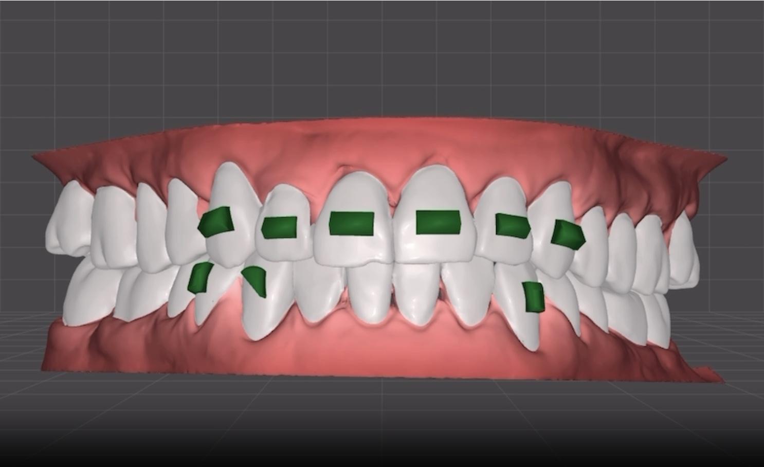 AC Aligners option 2