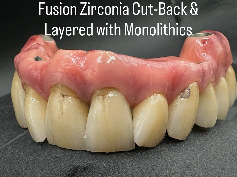 Fusion Zirconia Cutback & layered with monolithics