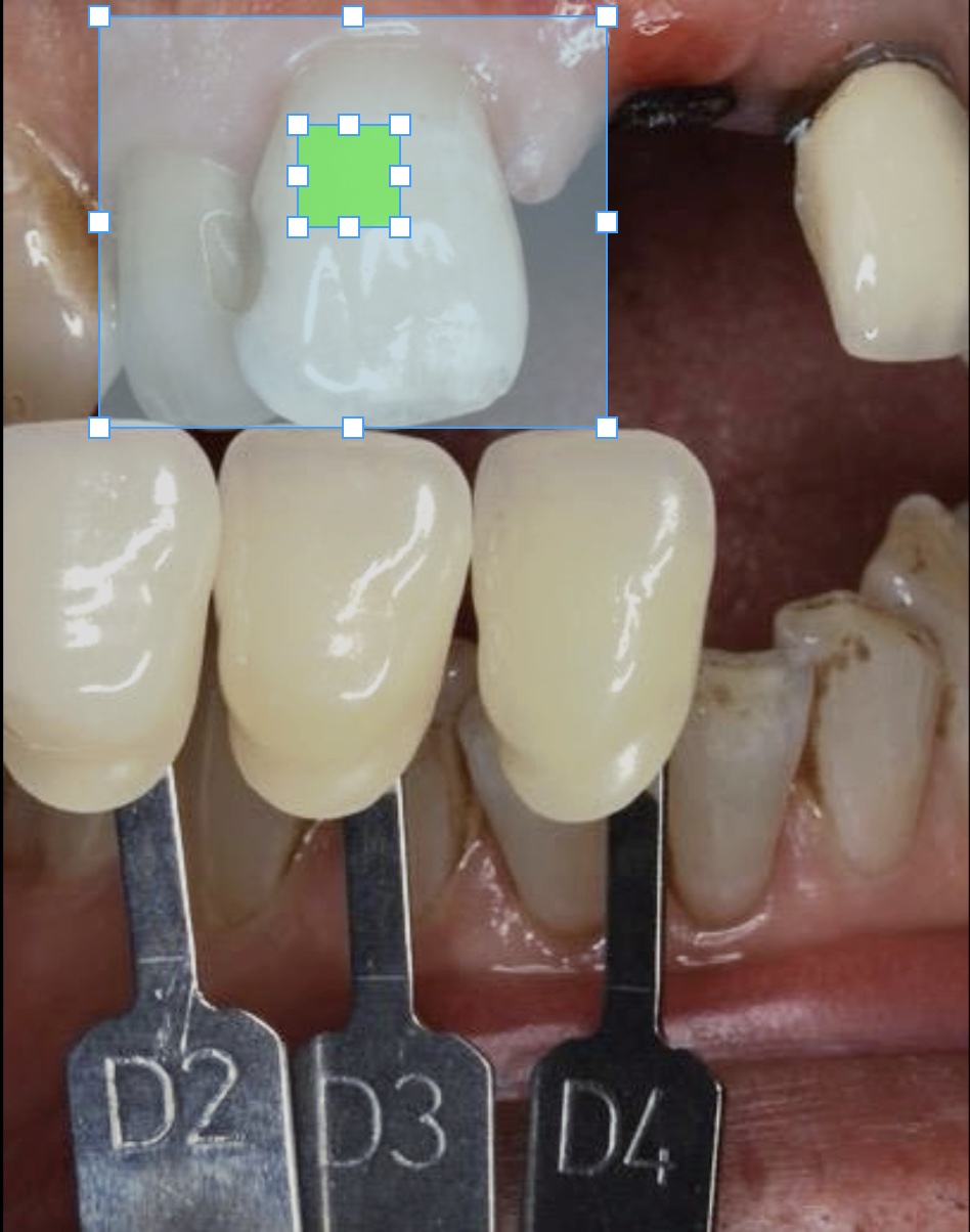 Selecting the gingival 1/3rd of the target tooth for analysis, where highest level of chroma exists.