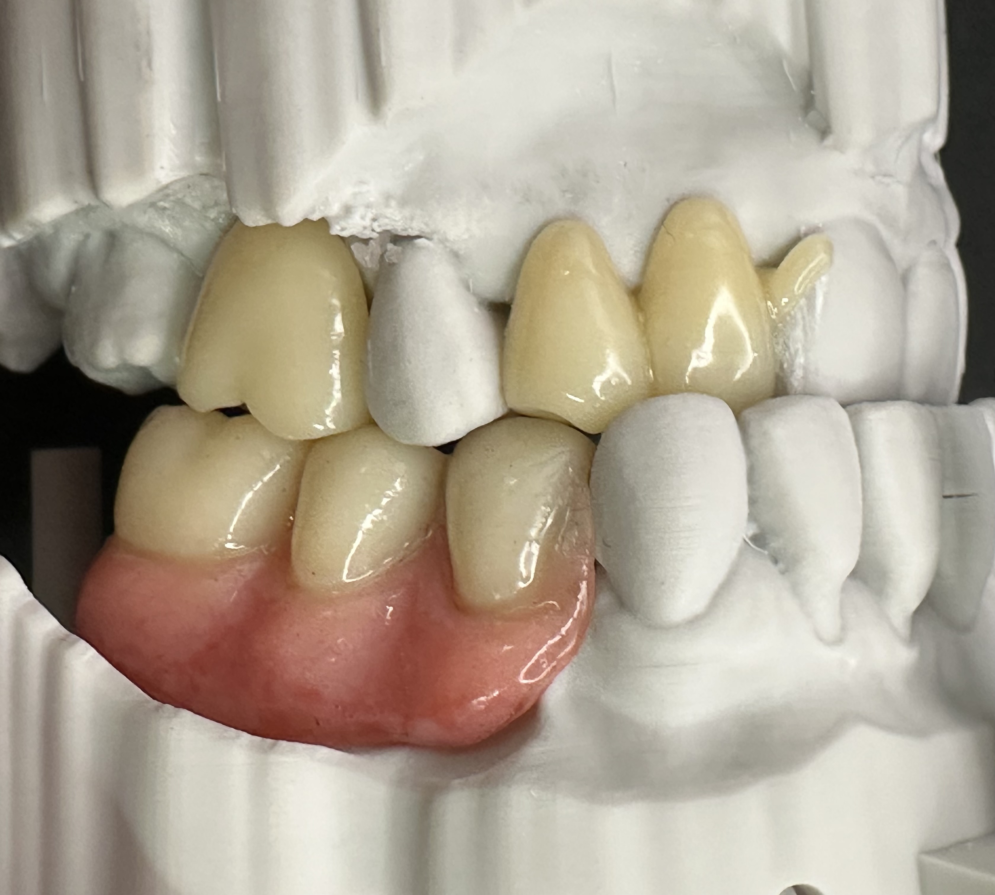 The RPDs harmonising with the natural dentition. Both in appearance and occlusion.