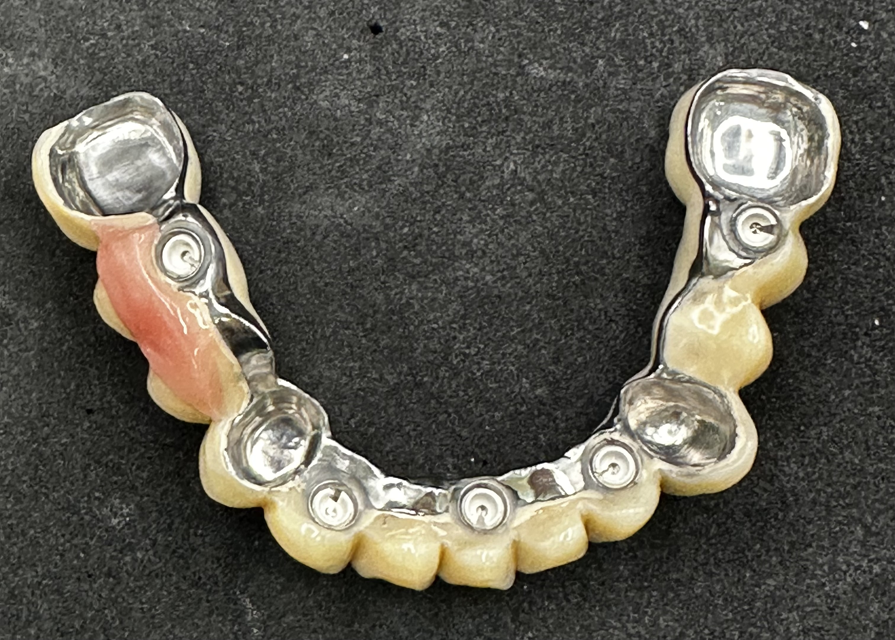 Framework with the cemented female locator parts clearly visible along with the inside of non-cemented copings to locate over milled cemented gold or zirconia copings already fitted.