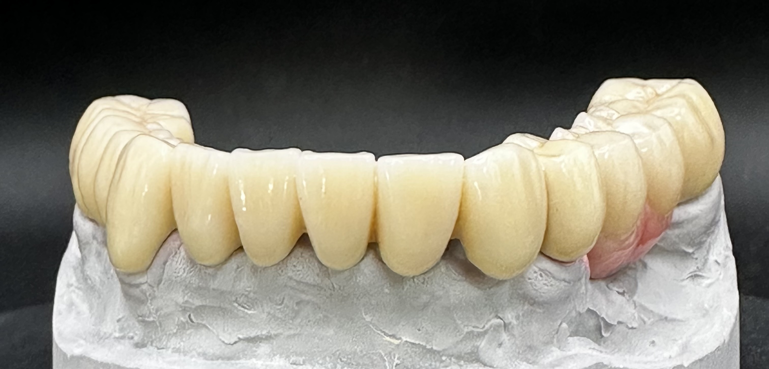 The close adaptation of the Pontic areas to the soft tissue.