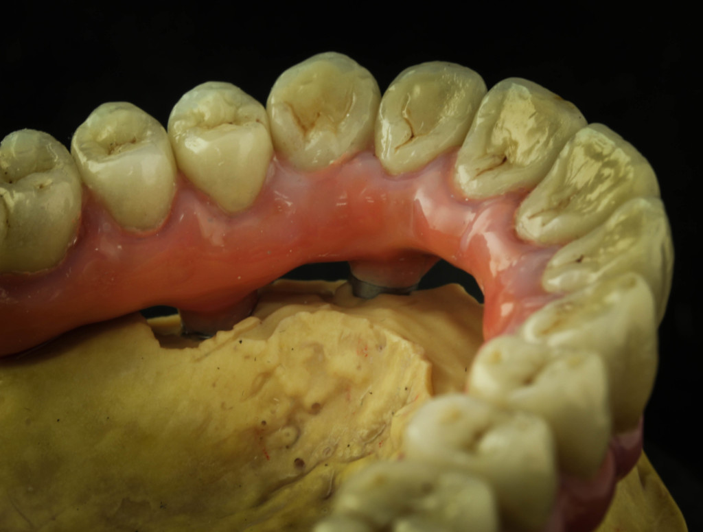 Milled_individual_crown_bridge